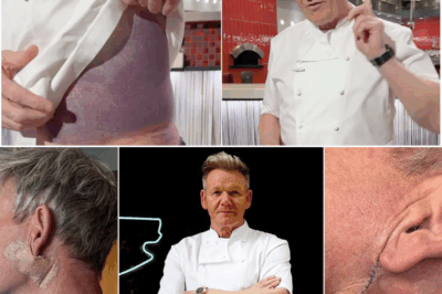 🚨👨‍🍳 “Take Care of Your Skin!” Gordon Ramsay Warns Fans After Surgery to Remove Basal Cell Carcinoma 😢🩺