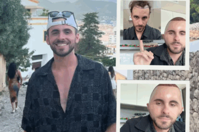 British Choreographer’s Hair Transplant Nightmare: Swollen Face Mimics Megamind in Viral Post-Op Horror